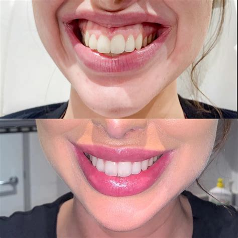 Best Gummy Smile Treatment In Australia Cutis Dermatology