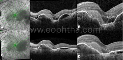 Choroidal Neovascular Membrane Oct