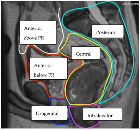 External Rectal Tumor