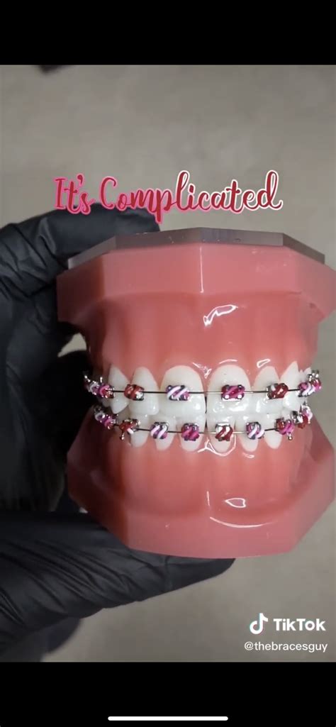 √ Braces Color Ideas