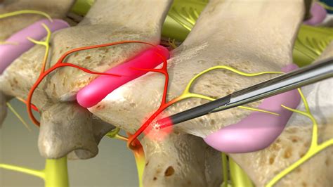 Radiofrequency Ablation (Rhizotomy) | Aptiva Health