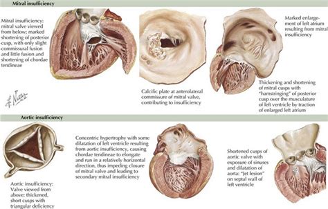 Mitral Valve Rheumatic Heart Disease Pregnant Center Informations