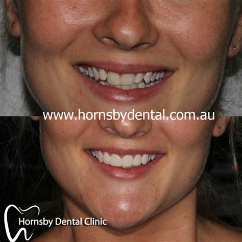 Root Canal Therapy Hornsby Hornsby Dental Clinic