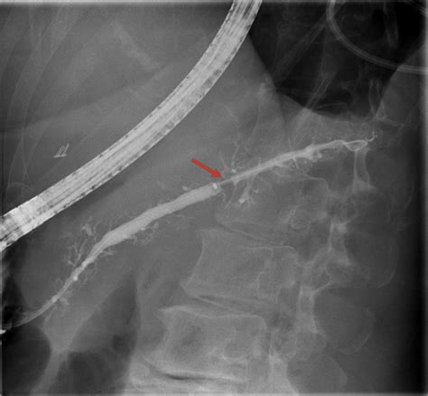 Pancreatoscopy Guided Laser Dissection And Ablation For Treatment Of Benign And Neoplastic