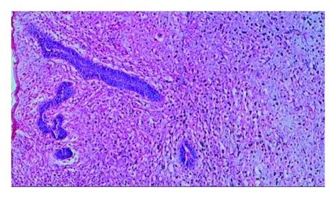 Photomicrograph Showing Cords And Islands Of Odontogenic Epithelium In