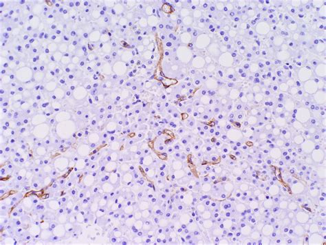 Hepatic Adenoma Gross