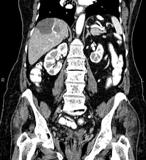 Gastric Gastrointestinal Stromal Tumor Image Radiopaedia Org