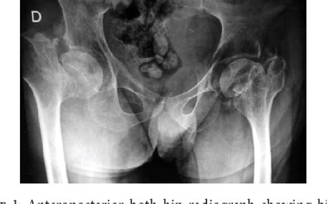 Figure 1 From Bilateral Simultaneous Femoral Neck Fracture Mimicking