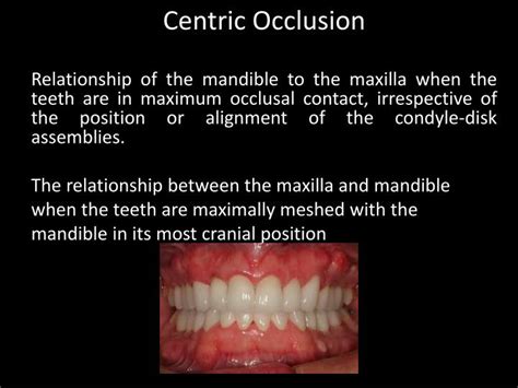 Ppt Fundamentals Of Occlusion Powerpoint Presentation Id 2143561