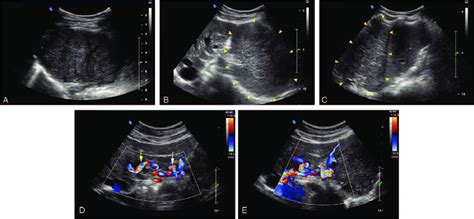 A Gray Scale Ultrasound A Well Defined Hypoechoic Mass Was Found