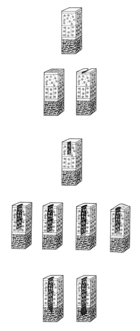 Grading Of Cartilage Lesion According To The International Cartilage