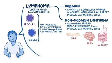 Linfoma Hodgkin