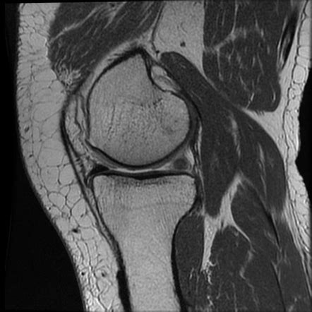 Medial Collateral Ligament Injury Of The Knee Radiology Reference