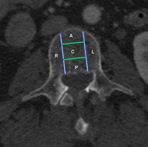 Vertebral Body Compression Fractures And Bone Density Automated