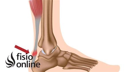 Rotura Del Tend N De Aquiles Causas S Ntomas Y Tratamiento Fisioonline