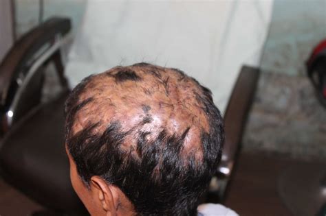 Folliculitis decalvans cured completely with Homeopathy in just 4 month