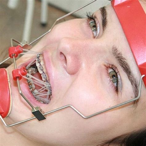 Braces Braceface Metalbraces Girlswithbraces Headgear Facemask