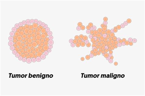 Qual A Diferen A Entre O Tumor Benigno E Maligno Sa De Em Tela