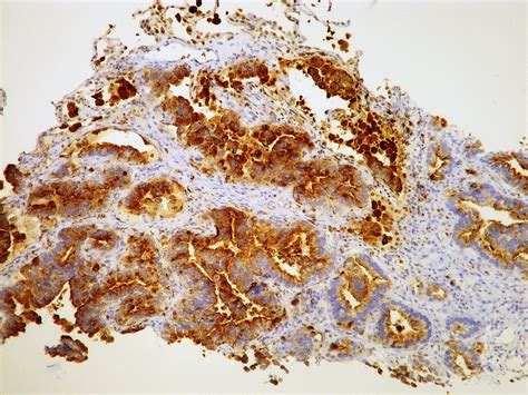 Adenocarcinoma Acinar Type Cea Yale Rosen Flickr