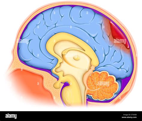 Brain Hemorrhage Illustration Stock Photos And Brain Hemorrhage