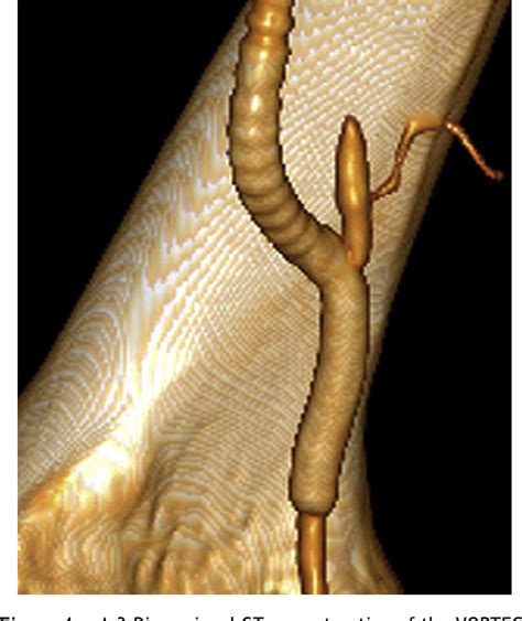 Figure From Use Of Viabahn Open Revascularisation Technique For Above