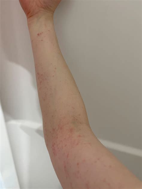 itchy skin rash : r/Dermatology