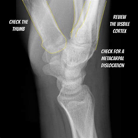 Wrist X Ray Review Illustrations Image