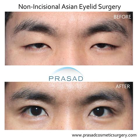 Double Eyelid Surgery Before And After Photos Dr Amiya Prasad