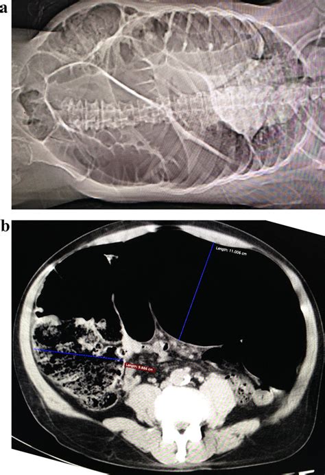 Aandb Ct Ski Gram A And Cross Section View B Of Abdomen