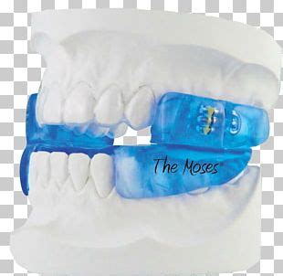 Obstructive Sleep Apnea Snoring Mandibular Advancement Splint Dentist ...