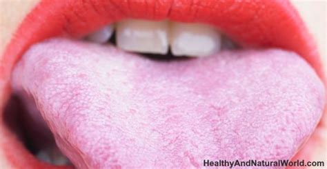 Bumps on Tongue: Causes and Natural Treatments