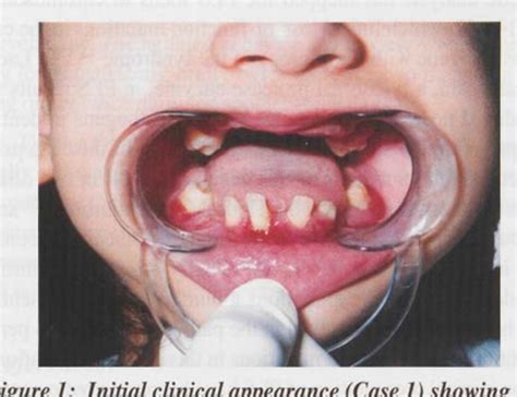 Figure 1 From Oral And Dermatologic Findings In Two Siblings With