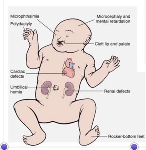 Congenital Anomalies CA Flashcards Quizlet