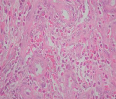 Histopathological Picture Of The Lesion Showing Plump Endothelial Cells Download Scientific