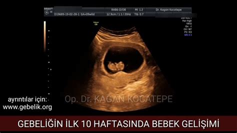 RAHİM İÇİNDEKİ BEBEĞİN 4 7 9 VE 10 HAFTALIK ULTRASON GÖRÜNTÜLERİ