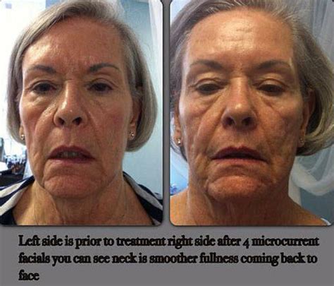 Microcurrent Treatment Before And After (1) » Facelift: Info, Prices ...