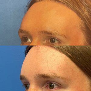 Facial Feminization Austin Tx Dr Weinfeld