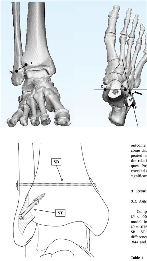 Figure 1 From Suture‐button Fixation And Anterior Inferior Tibiofibular