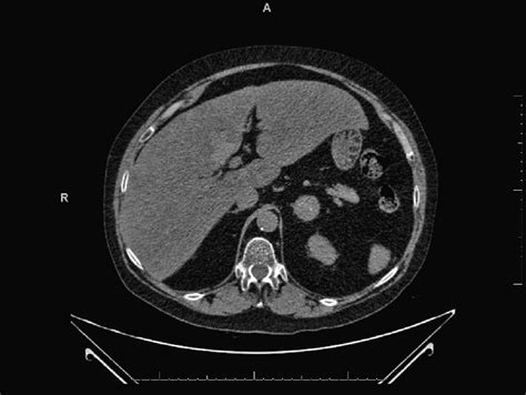 CT Abdomen Showing A 2 6 Cm Mass Within The Left Adrenal With A