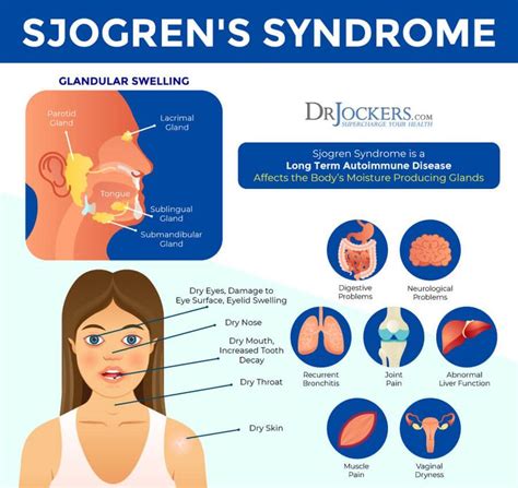 Sjogren’s Syndrome: Symptoms, Causes, and Natural Support Strategies ...