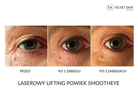 Laserowy Lifting Powiek SmoothEye Fotona Velvet Skin Clinic