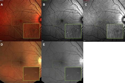 Diabetic Maculopathy Multicolour And Sd Oct Versus Fundus Photography