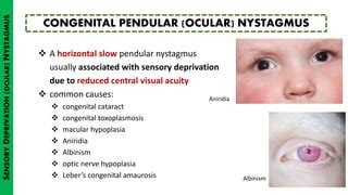 Nystagmus PPT