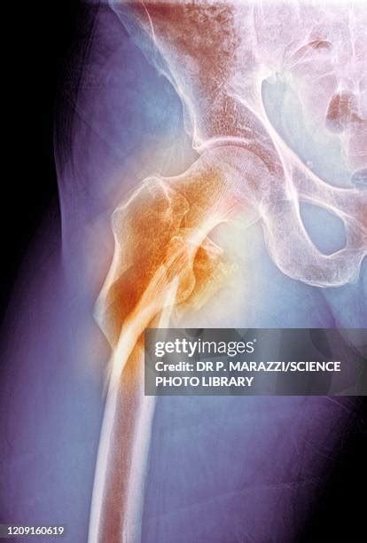 Hip Fracture X Ray Photos and Premium High Res Pictures - Getty Images