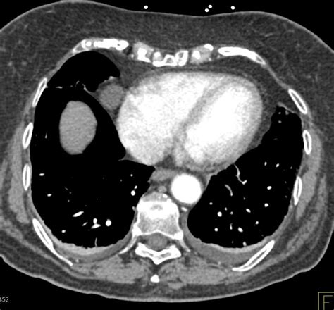 2cm Pericardial Cyst Cardiac Case Studies Ctisus Ct Scanning