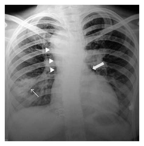 Chest Radiograph Frontal View Reveals Left Hilar Prominence Right Download Scientific Diagram