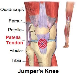 What Is Patellar Tendonitis Causes Symptoms Diagnosis And Treatment