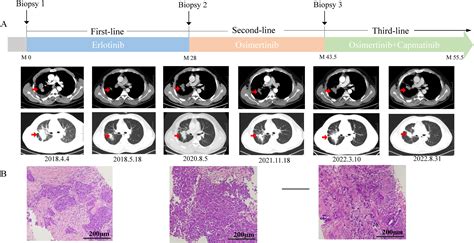 Presence Of Met Exon Skipping And Fusion As Mechanism Of Osimertinb