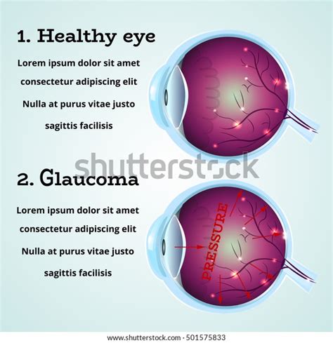 Estructura De Anatomía De La Enfermedad De Los Ojos Y Del Glaucoma Para