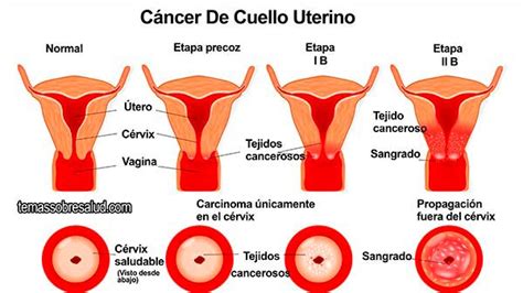 Síntomas Comunes Asociados Con El Cáncer De Cuello Uterino